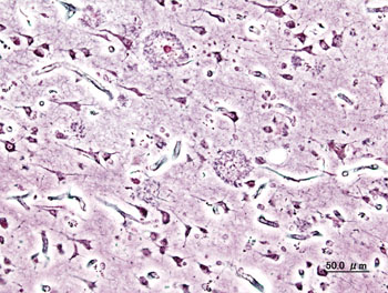 Image: A silver impregnation histopathologic photomicrograph of neurite plaques in the cerebral cortex of a person with Alzheimer\'s disease (Photo courtesy of Wikimedia Commons).