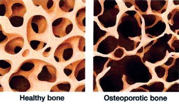 Image: The difference between normal and osteoporotic spongy bone can be seen (Photo courtesy of Mark A. Wolgin, MD).