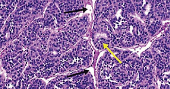 Image: A histopathology of insular thyroid carcinoma, showing the nesting patterns of the follicles (yellow arrow) and the artefactually created clefts (black arrows) (Photo courtesy of H. Lee Moffitt Cancer Center).
