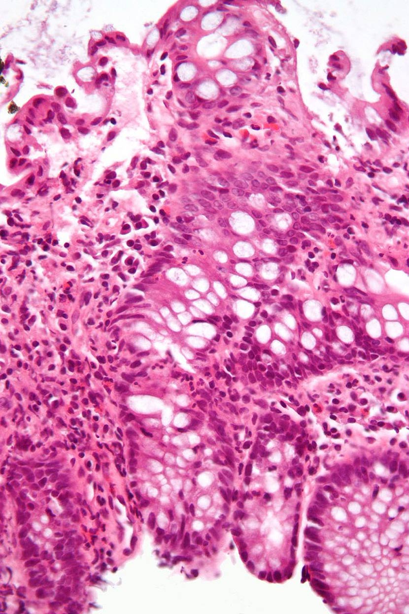 Image: A micrograph showing inflammation of the large bowel in a case of inflammatory bowel disease (Photo courtesy of Wikimedia Commons).