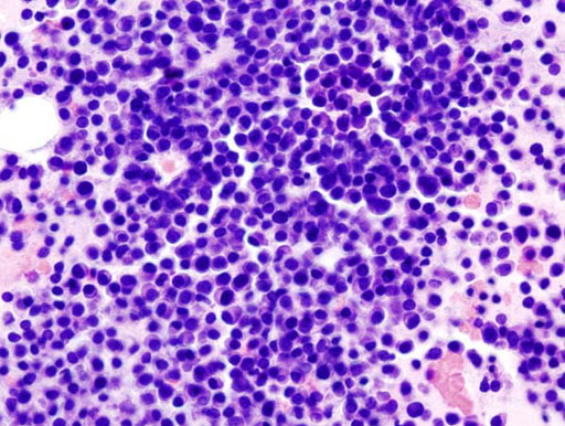 Image: A micrograph of bone marrow aspirate showing the histologic correlate of multiple myeloma (Photo courtesy of Wikimedia Commons).