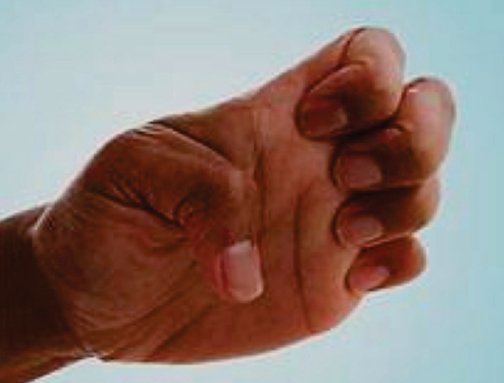 Image: Focal hand dystonia (Photo courtesy of Andrea Brachfeld).