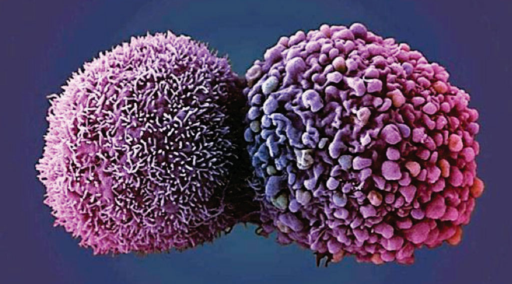 图片：两个肺癌细胞的扫描电镜彩色显微图像(SEM)（图片蒙英国癌症研究所的Anne Weston惠赐）。