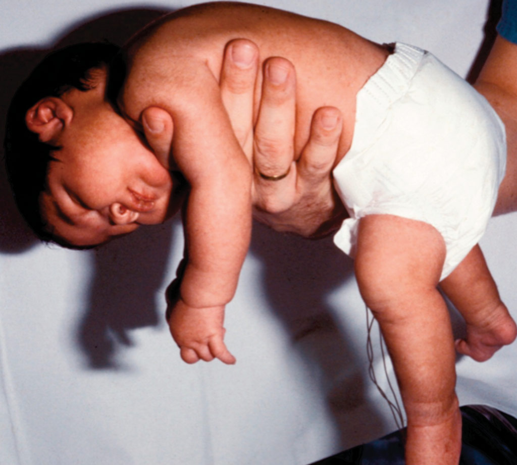 Image: An infant suffering from congenital hypotonia or muscle weakness (Photo courtesy of American Academy of Pediatrics).