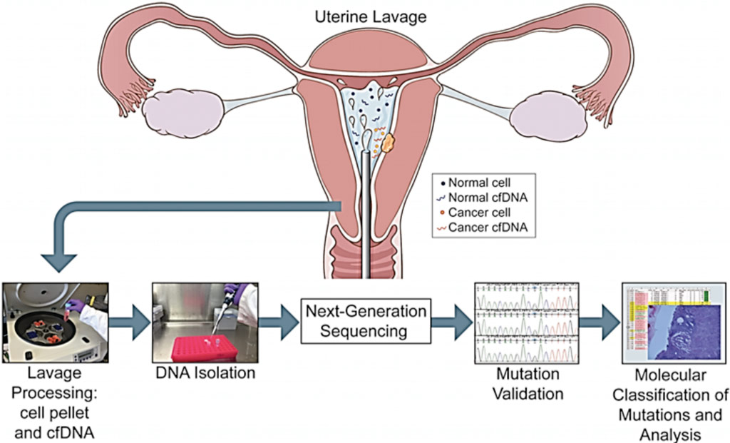 Image: Overview of the study pipeline beginning with collection of uterine lavage fluid at the initiation of hysteroscopy (Photo courtesy of Icahn School of Medicine at Mount Sinai).