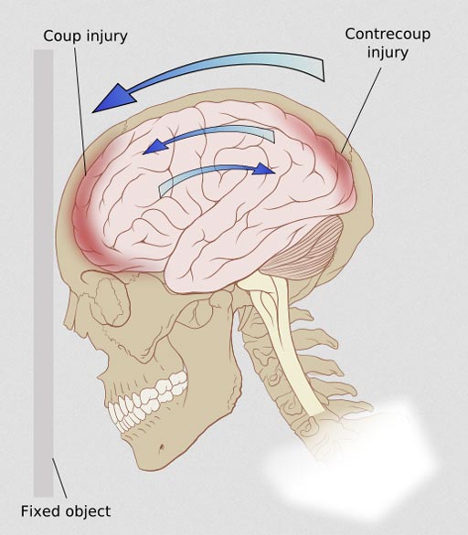 Image: A diagram of the forces on the brain in a coup-contrecoup concussion injury (Image courtesy of Wikimedia).