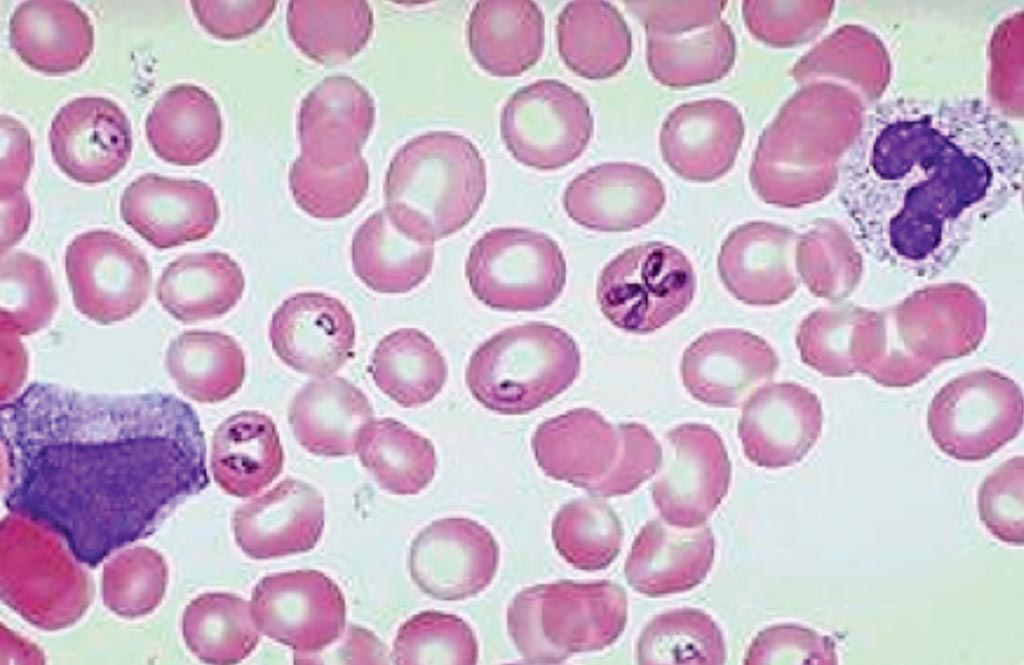 Image: Babesia microti in a thin blood smear stained with Giemsa (Photo courtesy of Spencer S. Eccles Health Sciences Library).