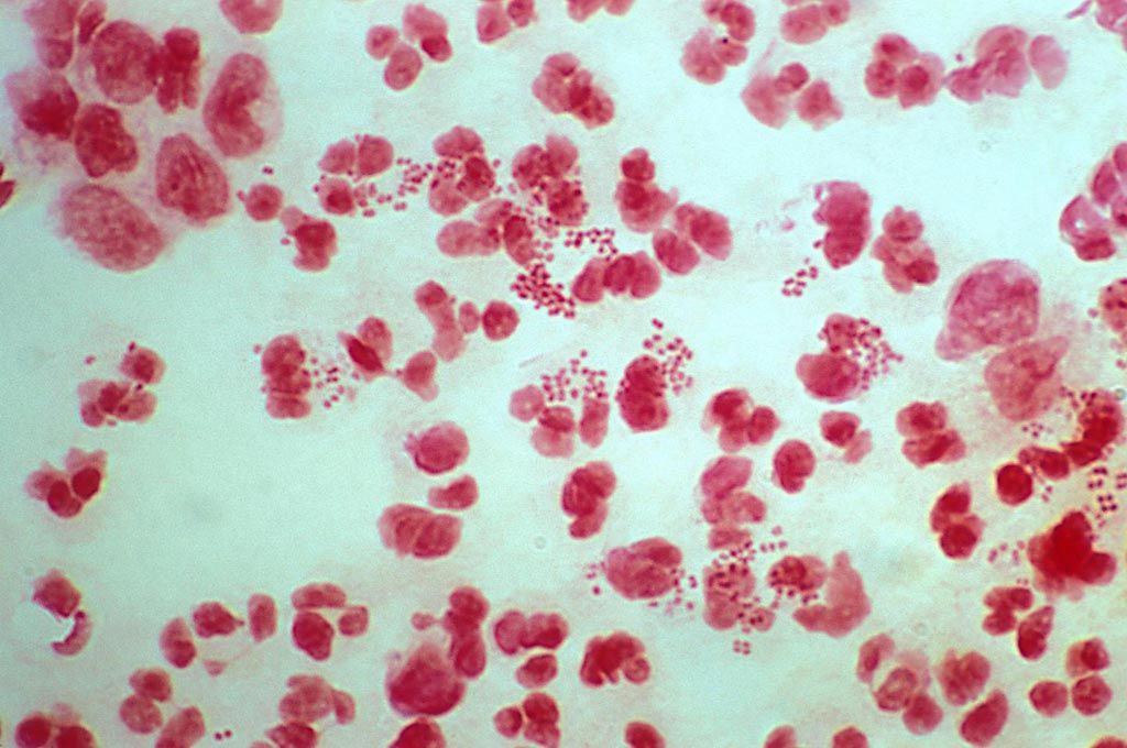 Image: A gonorrhea infection caused by the bacterium Neisseria gonorrhoeae (Photo courtesy of the University of York).