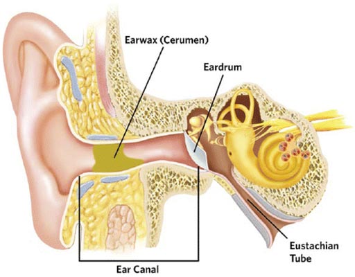 Image: Impacted cerumen (green-yellow in diagram) can completely obstruct the ear canal (Photo courtesy of Schwartz SR et al / American Academy of Otolaryngology – Head and Neck Surgery Foundation).