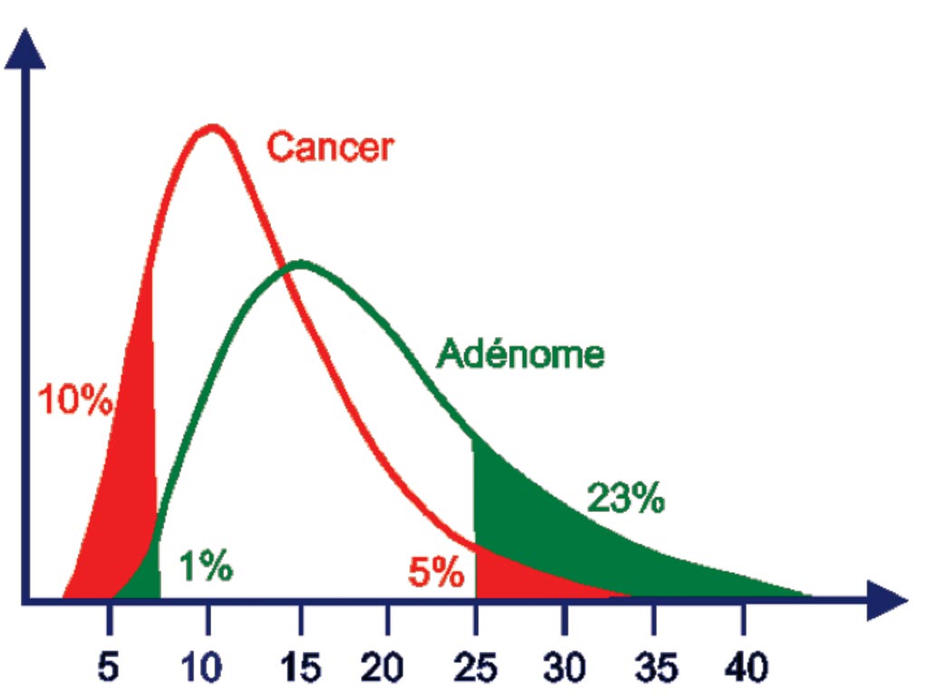 Image: The free Prostate-Specific Antigen (PSA) / total PSA fraction is significantly diminished in men with prostate cancer since almost all of the PSA is bound. When the fraction is under 10%, the risk of prostate cancer is high. When it is above 25%, the elevation of PSA is probably related to benign hyperplasia (Photo courtesy of Dianon Pathology).