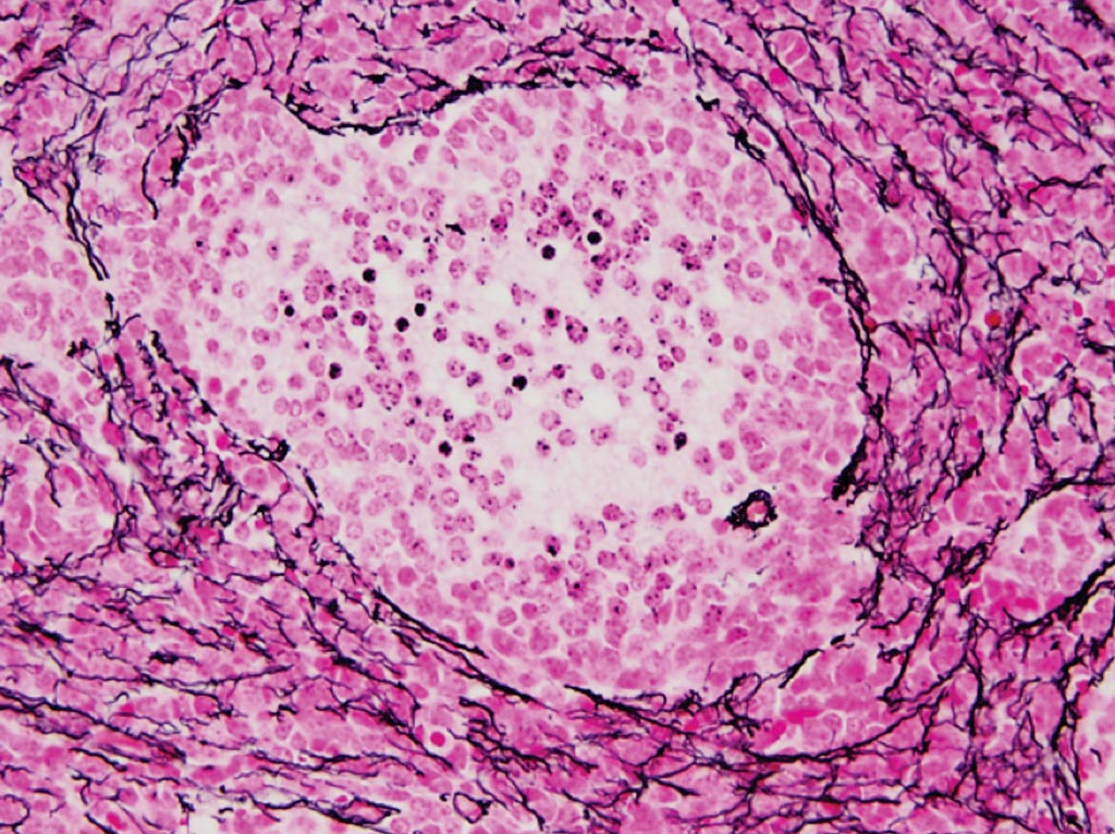 Image: A histopathology of a desmoplastic-nodular medulloblastoma, stained for reticulin. Reticulin fibers permeate the tumor but are absent in the center of the nodule (Photo courtesy of Dr. Dimitri Agamanolis, MD).