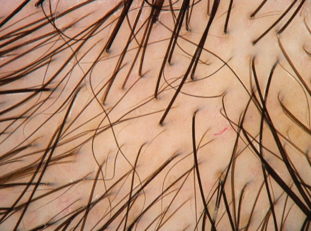 Image: Research shows analyzing cortisol levels in hair close to the scalp may be a reliable diagnostic method for Cushing\'s syndrome (Photo courtesy of Professor Antonella Tosti, MD).