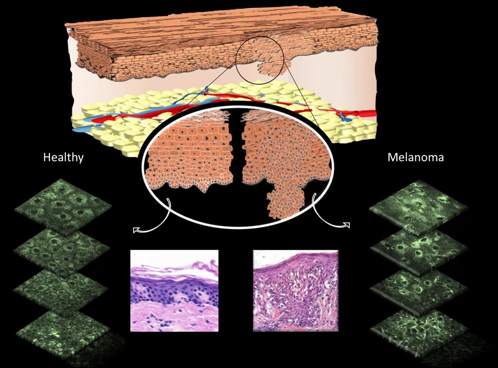 Image: A diagram showing differences that can be observed in cell morphology in normal skin cells versus melanomas (Photo courtesy of Irene Georgakoudi, Tufts University).
