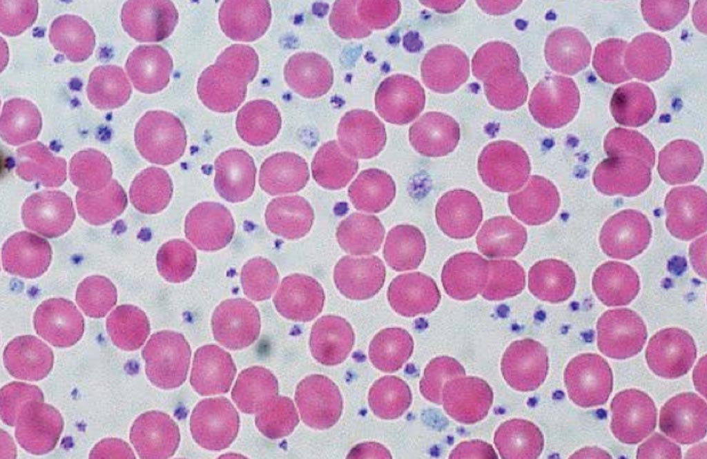 Image: Blood smear of a myeloproliferative neoplasia patient with a significant increase in the number of platelets (purple) as compared to the clearly larger red blood cells (Photo courtesy of Ed Uthman).