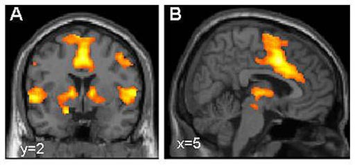 Image: Activation of the brain\'s fear network visualized using functional magnetic resonance imaging (MRI) (Photo courtesy of Dr. Tina Lonsdorf, Systems Neuroscience UKE Hamburg).