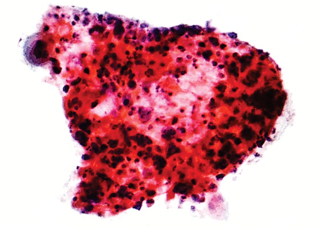 Image: A histology of a fine needle aspiration of a lung lesion showing a three-dimensional cluster of cells with the nuclear changes of malignancy: variation in nuclear size, staining and shape, and features of squamous differentiation: moderate amount of cytoplasm, small/indistinct nucleoli, nucleus in the cell center, and keratinization (Photo courtesy of Nephron).