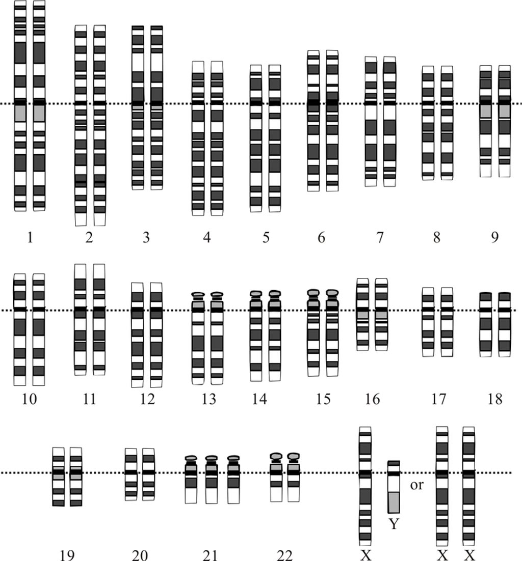 Image: Three copies of chromosome 21 characterize the karyotype for trisomy Down syndrome (Photo courtesy of Wikimedia Commons).