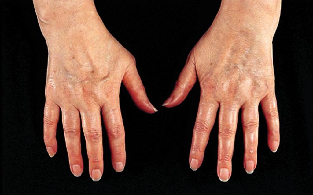 Image: The hands of a patient with early signs of rheumatoid arthritis (RA) (Photo courtesy of Dr. Gergely Péter).