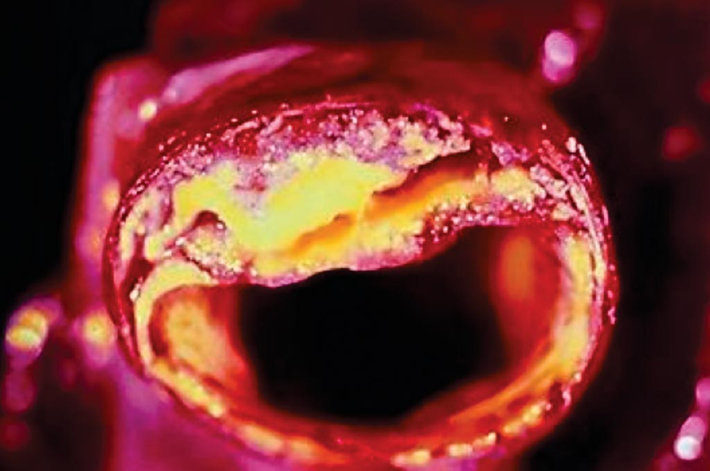 Image: A cross-section of an artery with atheroma visible in the upper section (Photo courtesy of Dr. Jules Y. T. Lam, MD).