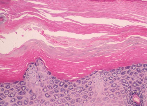 Image: A biopsy from the sole of the foot showing a recovered granular layer and a layer of parakeratosis sandwiched between the old orthokeratotic stratum corneum and a re-established orthokeratotic layer (Photo courtesy of SAMJ).