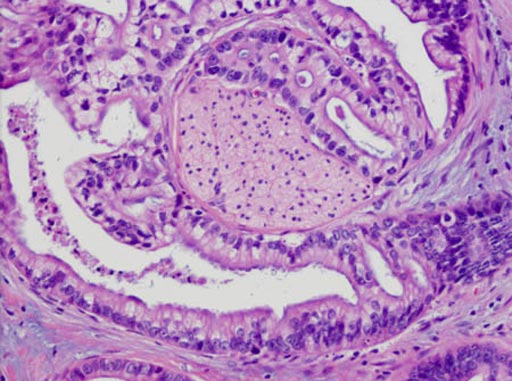 Image: A histopathology of pancreatic adenocarcinoma, where the adenocarcinoma has wrapped around a nerve (center) (Photo courtesy of Johns Hopkins Medicine).