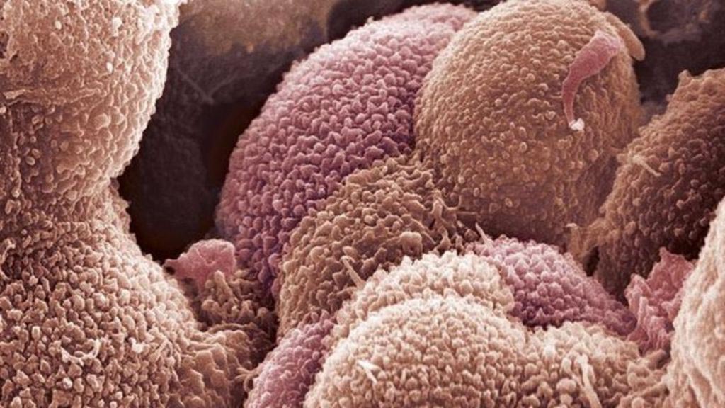 Image: A scanning electron micrograph (SEM) of ovarian cancer cells (Photo courtesy of SPL).
