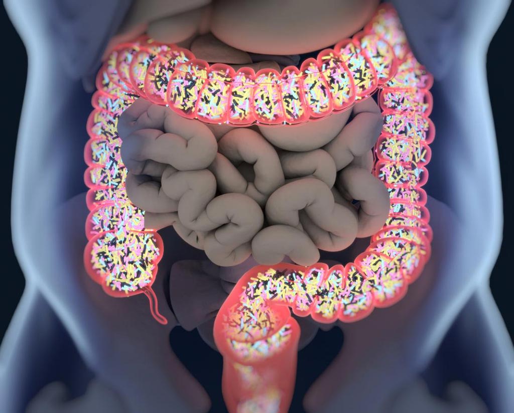 Image: The gut contains trillions of microorganisms, but new research finds one bacterium that drives the growth of colorectal cancer cells (Photo courtesy of MNT).