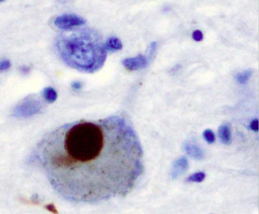 Image: Immunohistochemistry for alpha-synuclein showing positive staining (brown) of an intraneural Lewy-body in the brain substantia nigra in Parkinson\'s disease (Photo courtesy of Wikimedia).