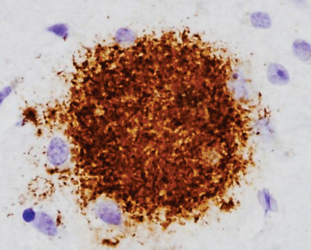 Image: Histopathology of an immunostained diffuse amyloid beta plaque in a brain sample from a patient with Alzheimer’s disease (Photo courtesy of Dr. Dimitri P. Agamanolis, MD).