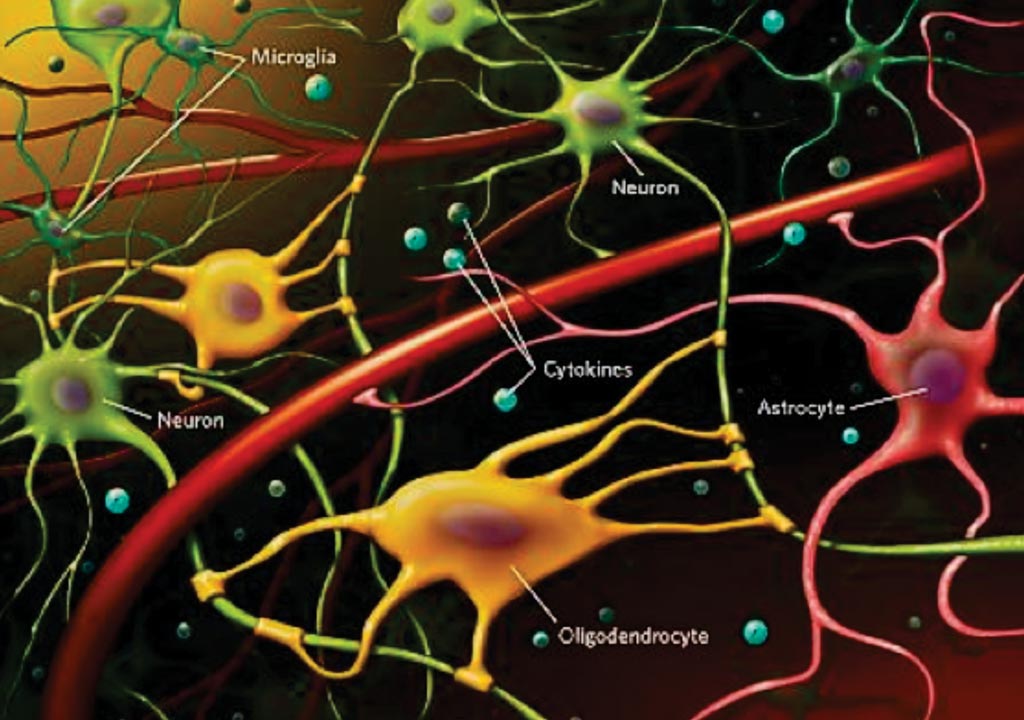 Image: Chronic neuro-inflammation as measured by high levels of circulating inflammatory cytokines and activated astrocytes and microglia in the brain (Photo courtesy of Dr. Oksana Kaidanovich-Beilin et al).