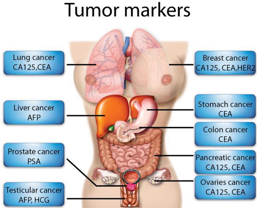 Image: Common tumor markers used in the diagnosis of cancer (Photo courtesy of Health Education Library).