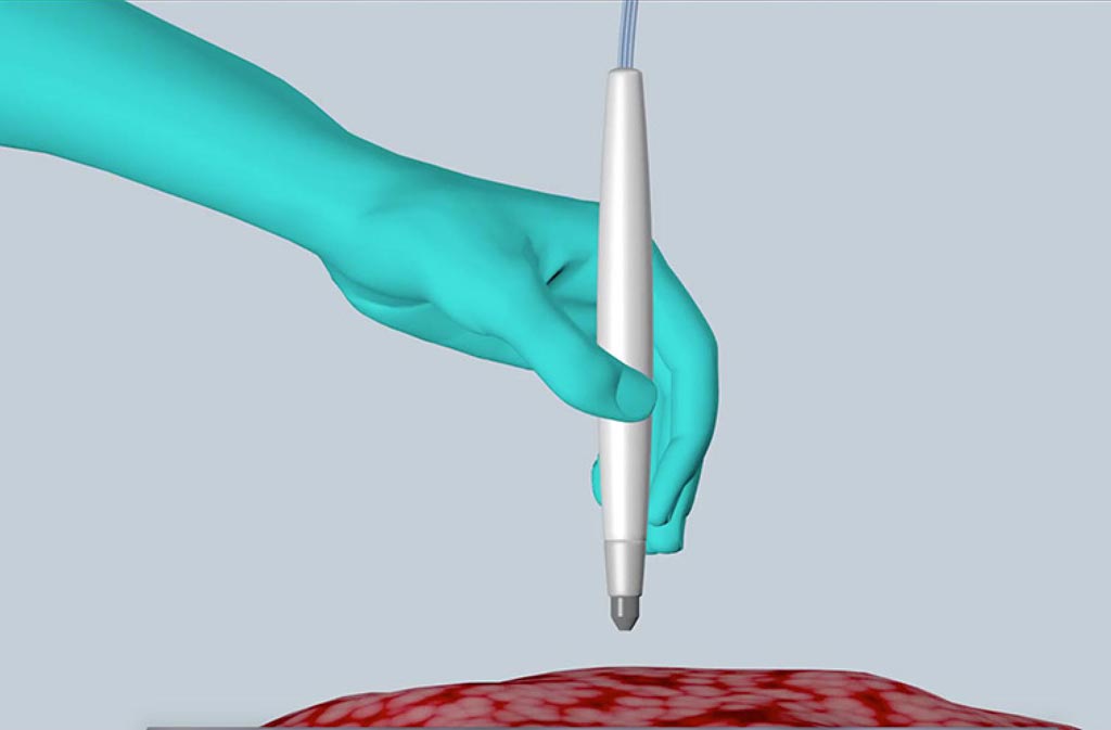 Image: The MasSpec Pen rapidly and accurately detects live cancer during surgery, helping improve treatment and reduce the chances of cancer recurrence (Photo courtesy of the University of Texas at Austin).