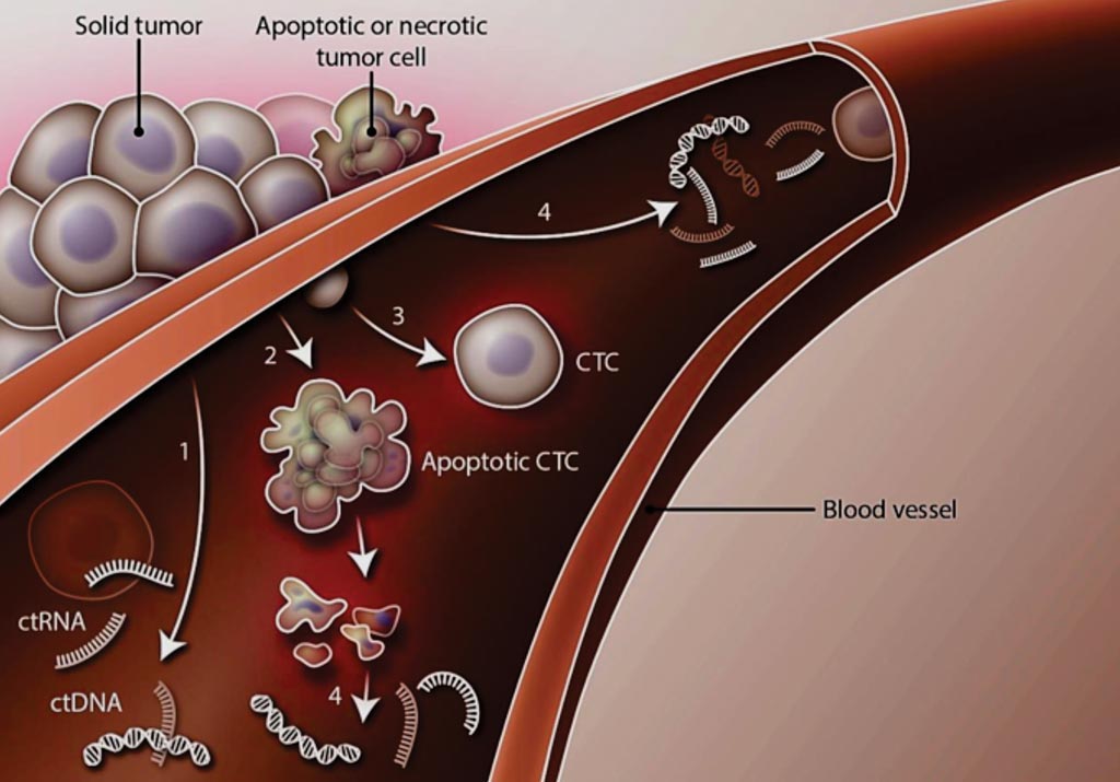 Image: Liquid Biopsy: Solid tumor masses may shed (1) circulating tumor DNA (ctDNA) and circulating tumor RNA (ctRNA), (2) apoptotic circulating tumor cells (CTCs), or (3) intact CTCs into the circulation. In addition, ctDNA and ctRNA may enter the bloodstream after apoptosis of circulating and non-circulating tumor cells (4) (Photo courtesy of H. McDonald / Science Translational Medicine).
