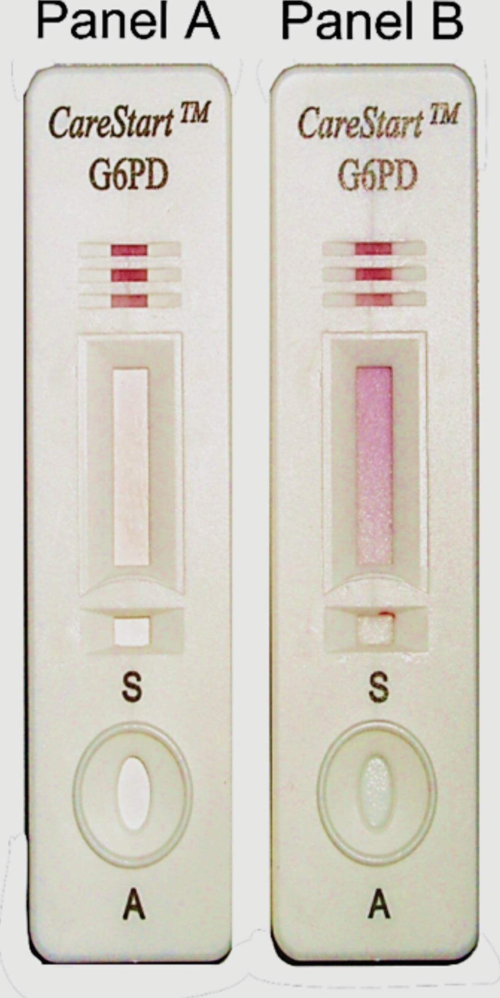 Image: The qualitative point-of-care test CareStart G6PD RDT is a visual screening test that identifies G6PD deficient patients using whole blood sample. Panel A, no color change for sample with deficient G6PD enzymatic activity; Panel B, distinct purple color for sample with normal G6PD enzymatic activity (Photo courtesy of Access Bio).