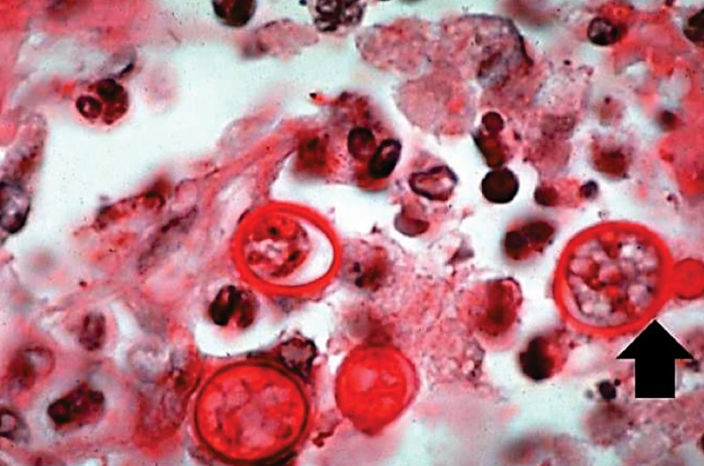 Image: A photomicrograph showing Blastomyces organisms stained with Periodic Acid Schiff (PAS). Note the budding organism (arrow) and the underlying pyogranulomatous inflammatory reaction in the background (Photo courtesy of University of Alabama at Birmingham).