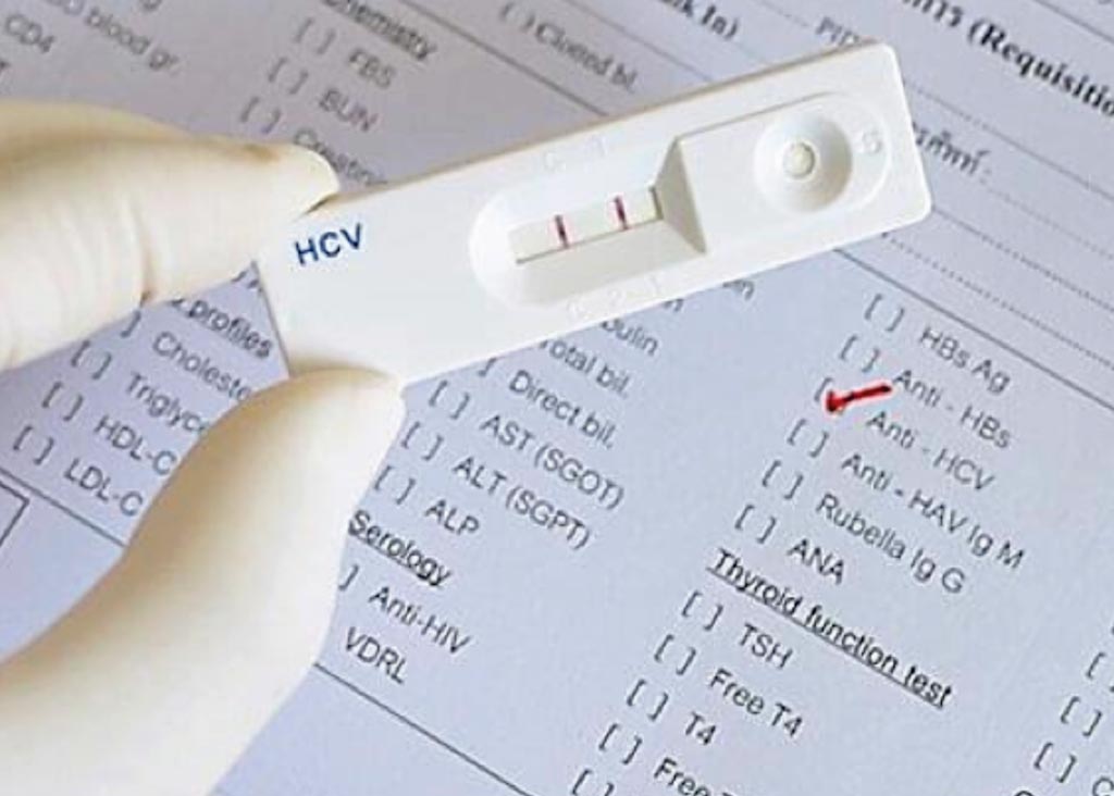 Image: Hepatitis C virus (HCV) tests are immunochromatographic rapid tests for the qualitative detection of antibodies specific to HCV in human serum, plasma or whole blood (Photo courtesy of Dr. Robert Cox, MD).