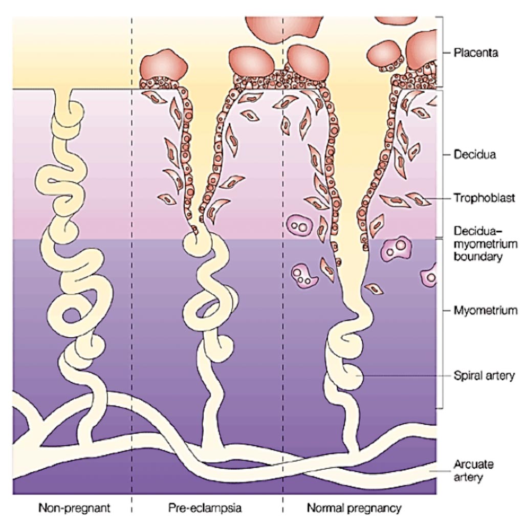 Image: A diagram of the preeclampsia placenta compared to a normal placenta (Photo courtesy of the University of Dundee).