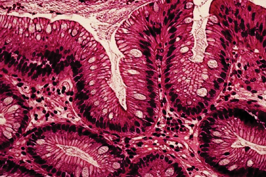Image: A histopathology of Barrett\'s esophagus, characterized by the presence of specialized columnar epithelium with goblet cells (Photo courtesy of Dr. John R Goldblum, MD).