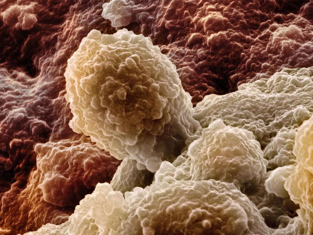图片：前列腺癌细胞的扫描电子显微照片（SEM）（照片由 David McCarthy 提供）。
