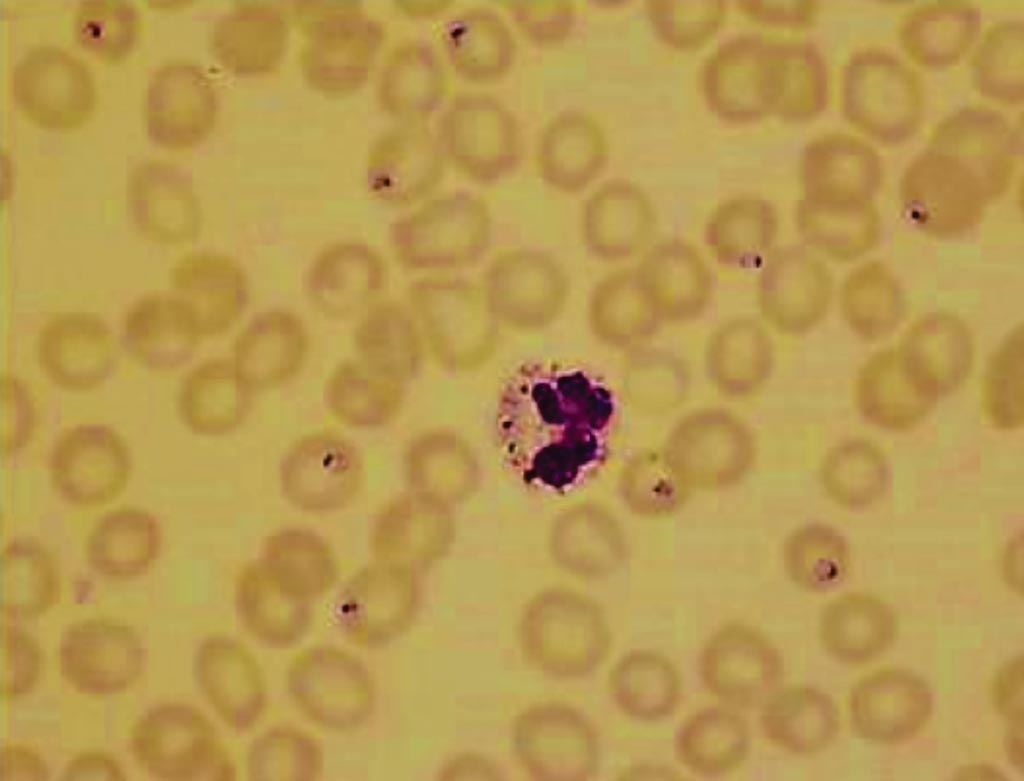 Image: Thin blood film showing ring-form trophozoites of Plasmodium falciparum and a neutrophil containing malaria pigment (Photo courtesy of Hammersmith Hospital).