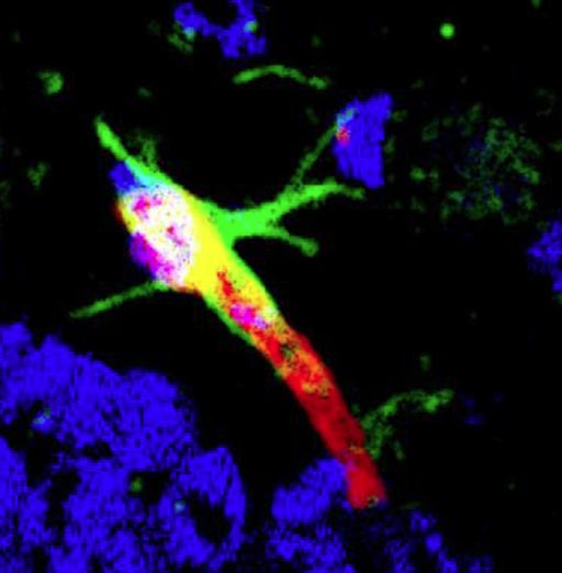 Image: A photomicrograph showing DAG (green-labeled peptide) targeting to the brain blood vessel (labeled red) in the hippocampus of the Alzheimer brain (Photo courtesy of the Ruoslahti Laboratory, Sanford-Burnham Prebys Medical Discovery Institute).