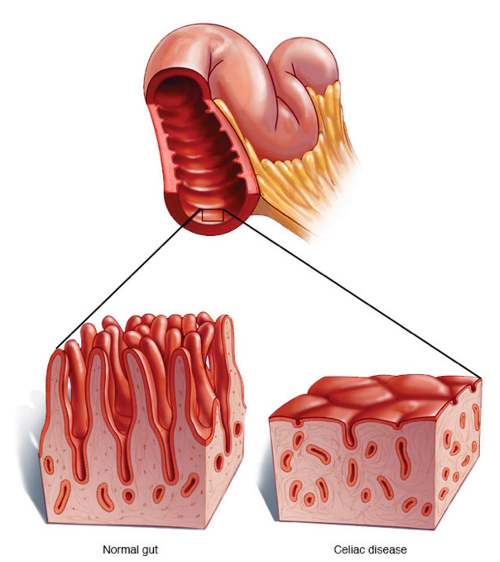 Image: A diagram comparing the small intestine in Celiac disease with damaged villi and a normal bowel (Photo courtesy of the Mayo Clinic).
