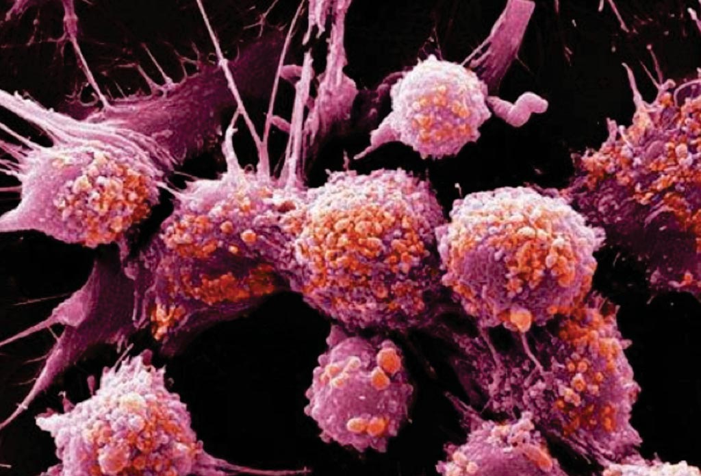 Image: A scanning electron photomicrograph (SEM) of prostate cancer cells (Photo courtesy of Prostate Cancer UK).