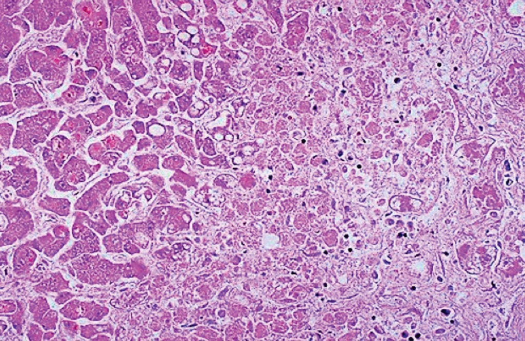 Image: A histopathology of extensive hepatocyte necrosis seen here in a case of paracetamol overdose. The hepatocytes at the right are dead, and those at the left are dying. This pattern can be seen with a variety of hepatotoxins (Photo courtesy of the University of Utah Medical School).