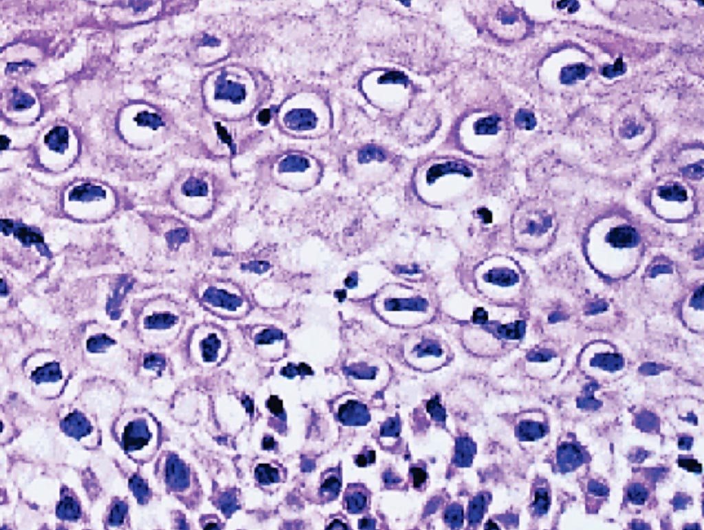 Image: A photomicrograph of a cervical cancer biopsy. Many squamous cells show dark nuclei surrounded by a clear halo. These are koilocytes and indicative of human papillomavirus (HPV) infection (Photo courtesy of Newcastle University).
