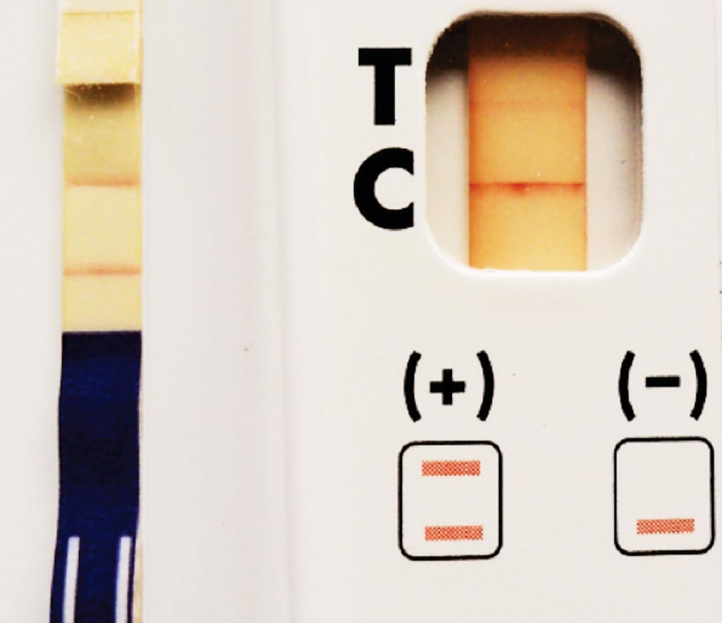 Тест-полоска Alere Filariasis Test Strip (FTS) (левая панель, резко-положительная) и иммунохроматографическая карта BinaxNOW Filariasis (правая панель, слабо-положительная) – варианты тестов для иммунологического обследования in vitro, используемые для обнаружения антигена Wuchereria bancrofti в цельной крови, сыворотке или плазме (фото любезно предоставлено доктором Питером У. Фишером [Peter U. Fischer]).