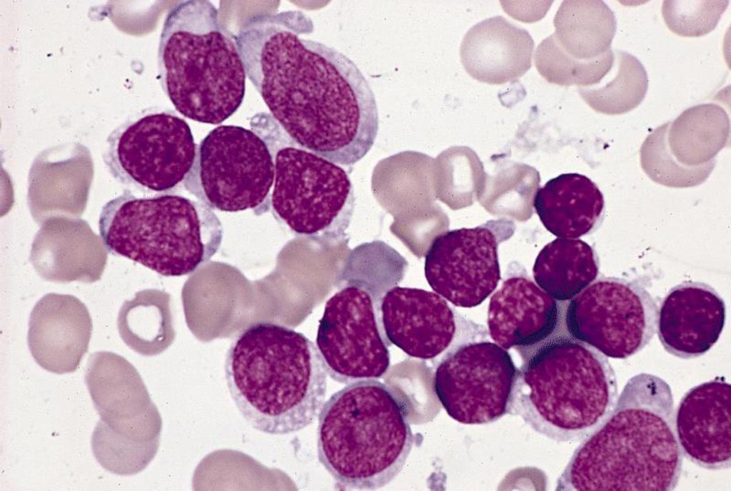 Image: Acute lymphoblastic leukemia (Photo courtesy of Pathology Outlines).