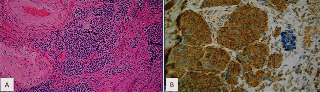 Image: (A) Histology of a case of olfactory neuroblastoma with upregulation of CD24 gene by microarray, (B) confirmed by CD24 protein overexpression in the tumor cells (Photo courtesy of Caris Life Sciences).