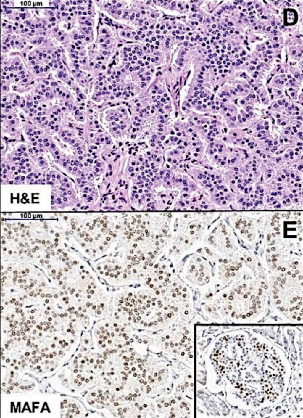 Image: Histopathology: (D) H&E staining showing the trabecular pattern of MAFA mutation-positive insulinomas. (E) Immunostaining shows diffuse MAFA expression in the tumor, at lower levels compared with the neighboring normal islets strongly expressing MAFA (Inset) (Photo courtesy of the Queen Mary University of London).