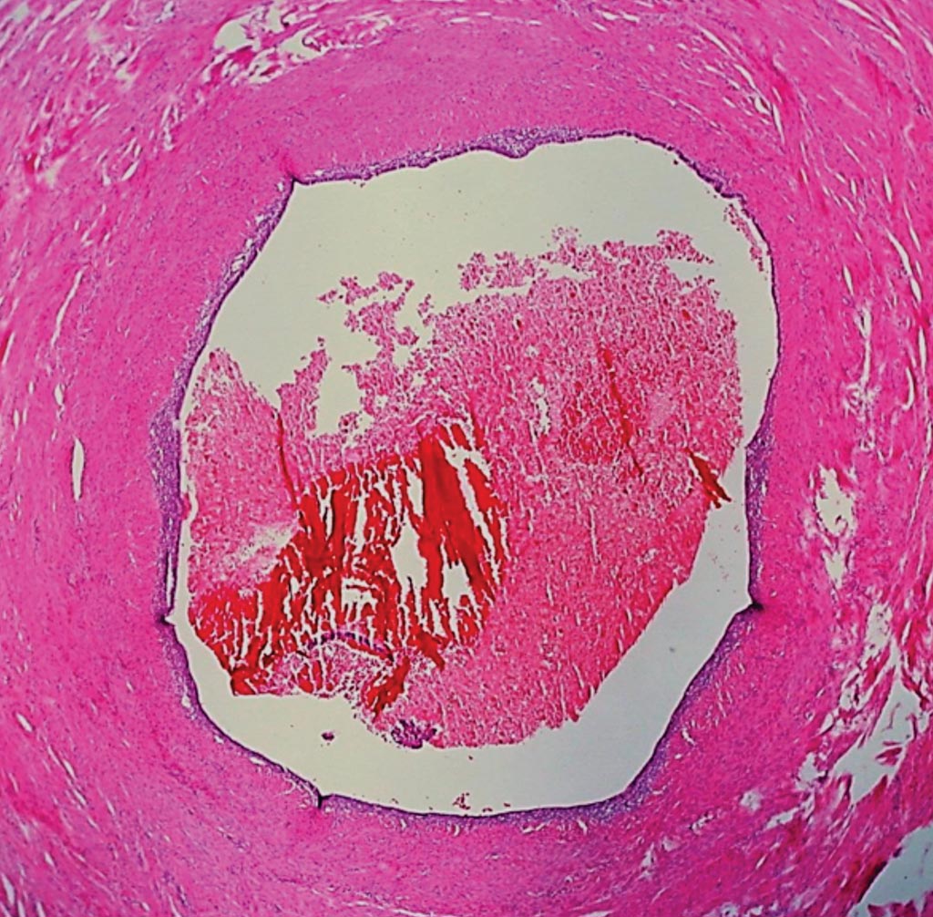 Image: Histopathology of Endometriosis of the Fallopian Tube (Luminal Pattern). In this pattern, the normal complex, folded tubal mucosa is replaced by flat columnar epithelium with a tin underpinning of specialized endometrial stroma. There are also blood cells in the lumen Photo courtesy of Dr. Ed Uthman).